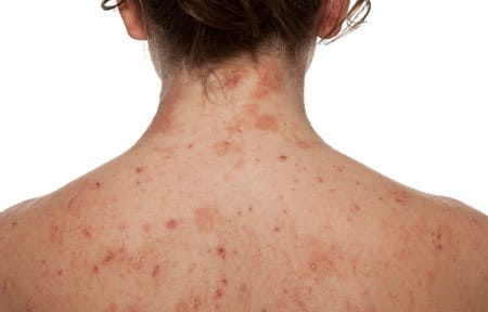 Con quale frequenza pungere diprospan a psoriasi