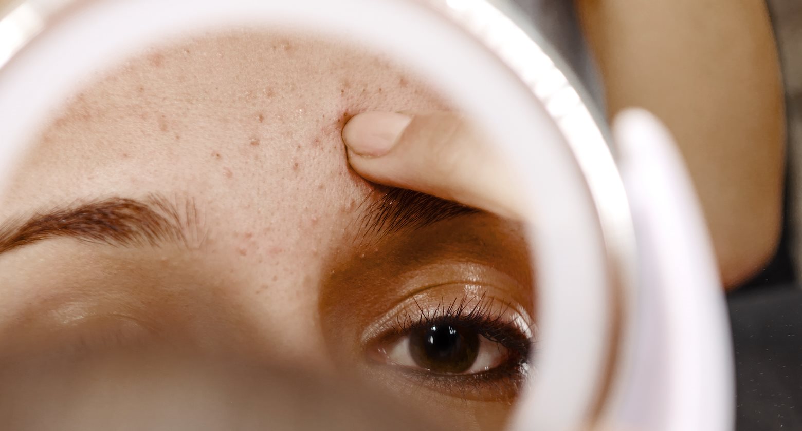 Akne und die verschiedenen Arten | Akneformen | Eucerin