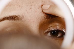 Akne-Formen, Akne-Arten, Akneformen, Aknearten