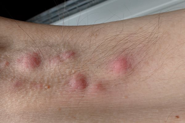 Acne Inversa Symptome Erkennen Und Behandeln Eucerin