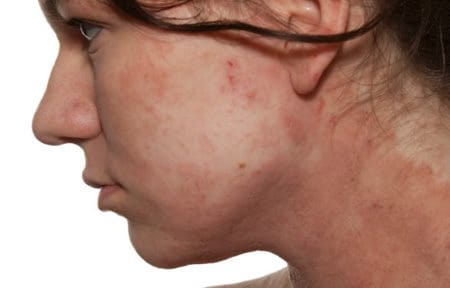 Le psoriasis ont disparu les patches