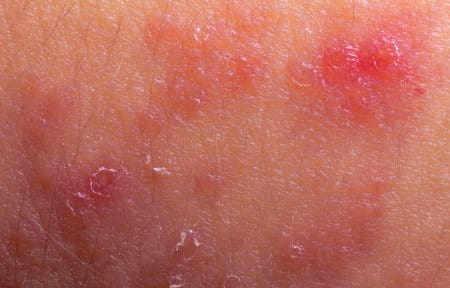 Schuppige Gesichtshaut Die Richtige Pflege Hilft Flaconi