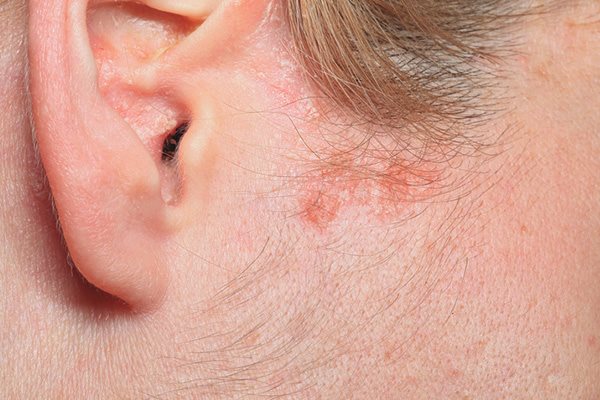 Neurodermitis Auf Der Kopfhaut Bilder www.eucerin.de