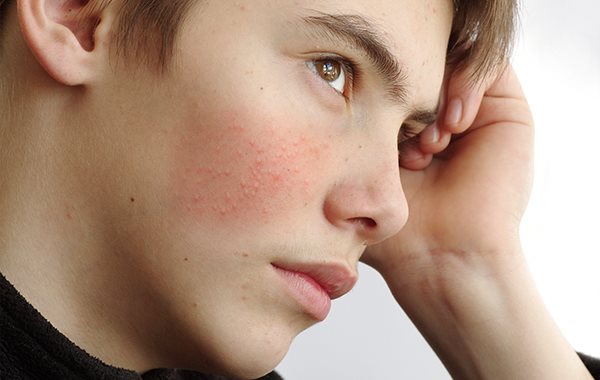 Get Pickel Im Mundbereich Mann PNG