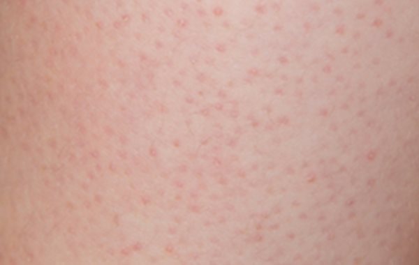 Biologikatherapie Mit Antiil17aantikrper Verbessert Biologikatherapie Mit Antiil17aantikrper Verbessert