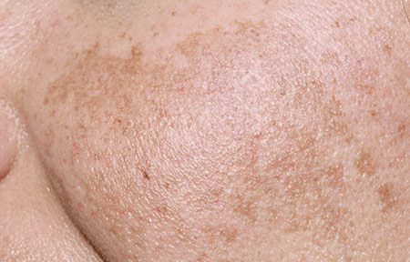 Nahaufnahme der Wange einer Frau mit Melasma