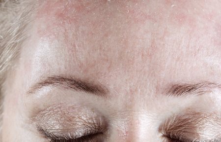 Schuppige Stirn einer Frau