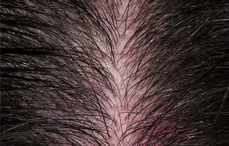 Kreisrunder Haarausfall Rote Kopfhaut Kreisrunder Haarausfall Rote Kopfhaut