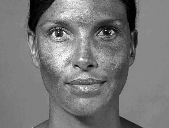 Sonnenschäden der Haut werden durch die UV-Kamera deutlich