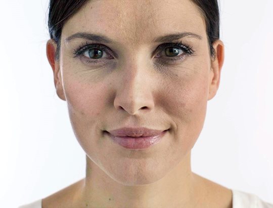 Sun-induced skin damage revealed by UV camera